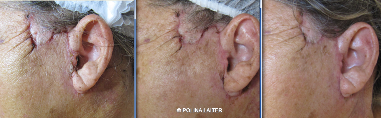 Полина Лайтер :: Реабилитационная  программа Reface for plastic