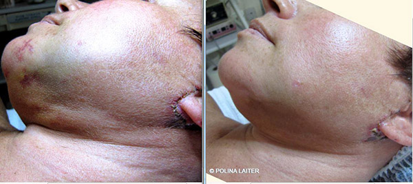 Полина Лайтер :: Реабилитационная  программа Reface for plastic