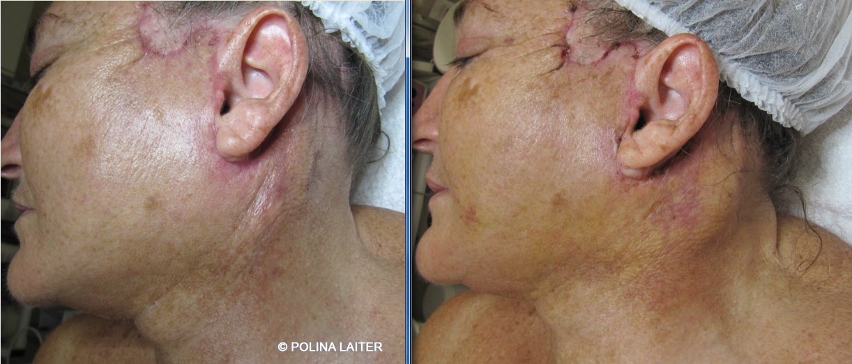 Полина Лайтер :: Реабилитационная  программа Reface for plastic