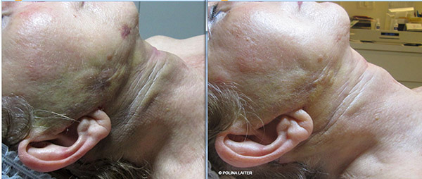 Полина Лайтер :: Реабилитационная  программа Reface for plastic